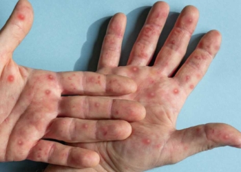 Confirman dos casos de viruela del mono en el Atlántico